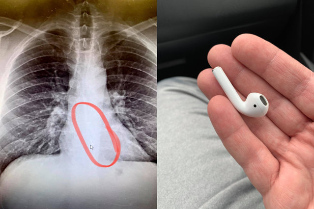 Căştile wireless pot fi periculoase în timpul somnului. Un bărbat a fost operat de urgenţă după ce medicii i-au găsit un AirPod în esofag