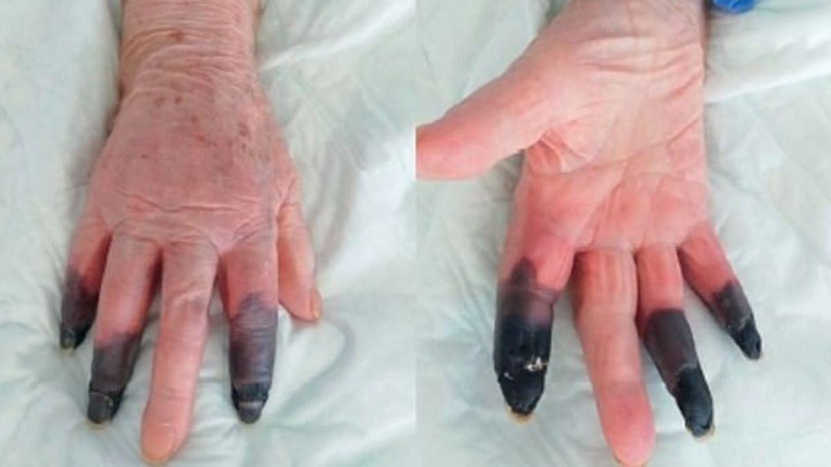 Doctorii i-au amputat trei degete după ce s-a infectat cu SARS-CoV-2