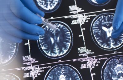 Poluarea aerului crește riscul de Alzheimer – studiu amplu pe 27 de milioane de persoane